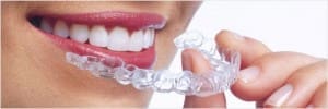 Traitement Invisalign